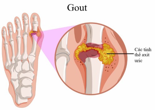 nấm linh chi trị bệnh gout hiệu quả như thế nào